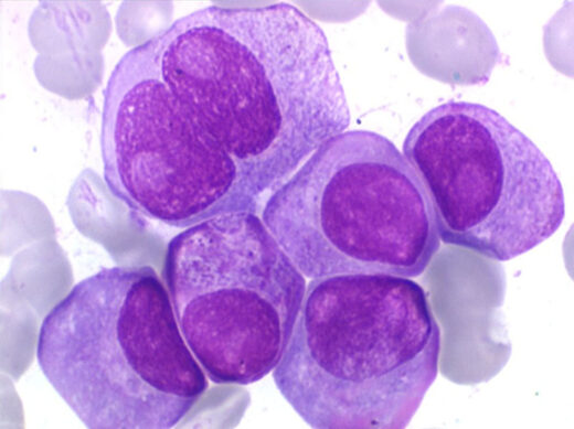 Myélome multiple et autogreffe des cellules souches