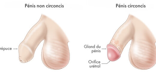 Circoncision ou frenectomie du pénis