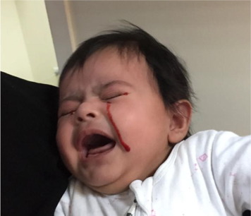 Haemolacria traitement naturel