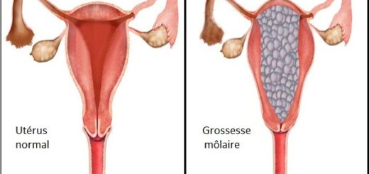 Grossesses molaires traitement naturel