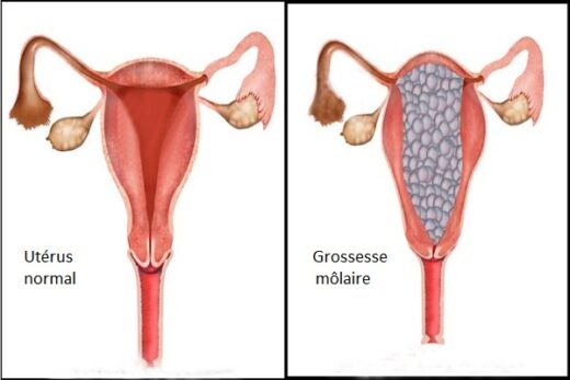 Grossesses molaires traitement naturel
