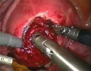 Est-il possible d'accoucher par voie basse avec un fibrome ?