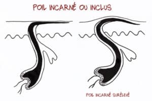 Poils incarnés maillot solution miracle