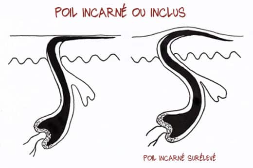 Poils incarnés maillot solution miracle