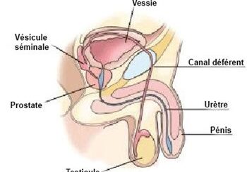 Résection transurétrale de la prostate