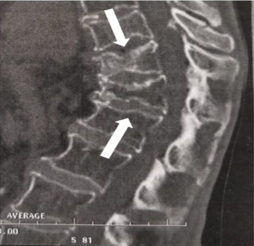 Tassement vertébral traitement naturel