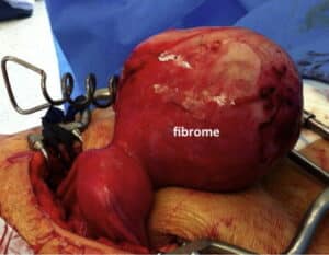 Fibrome et grossesse à 40 ans