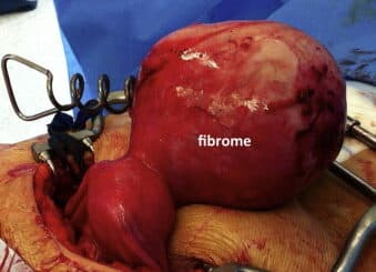 Fibrome et grossesse à 40 ans