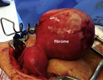 Fibrome et grossesse à 40 ans