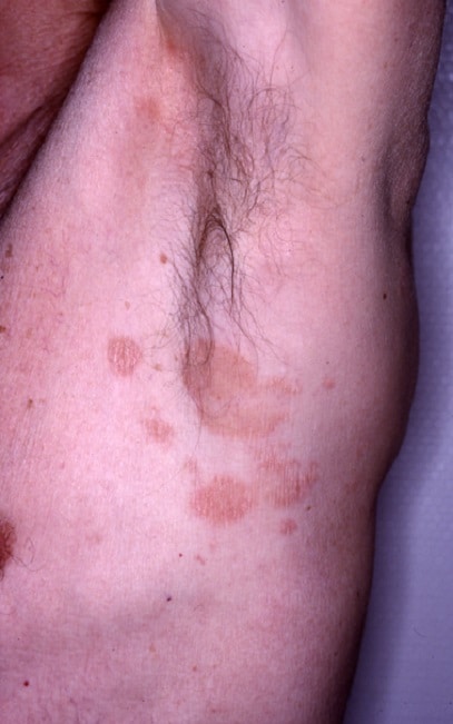 guérir d'un lymphome stade 4