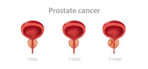 Taux guérison cancer prostate curiethérapie