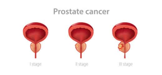 Taux guérison cancer prostate curiethérapie