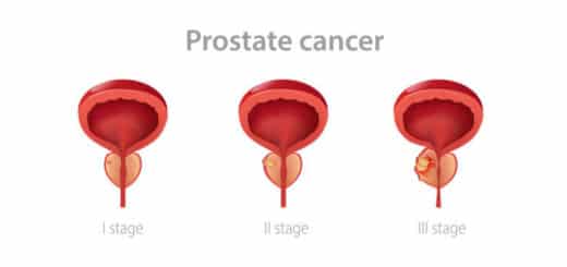 Taux guérison cancer prostate curiethérapie