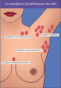 j ai un ganglion intra mammaire