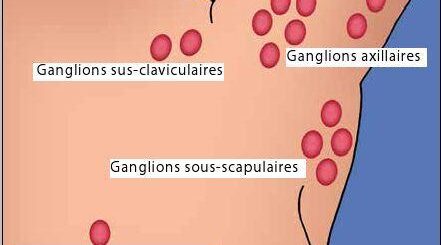j ai un ganglion intra mammaire