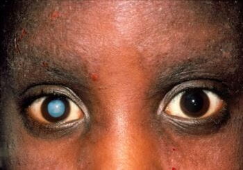 Cataracte complications inflammatoires