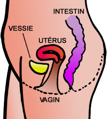Problèmes intestinaux apres hystérectomie