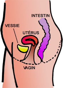 Problèmes intestinaux apres hystérectomie