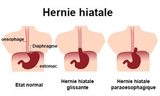Opération hernie hiatale effets secondaires
