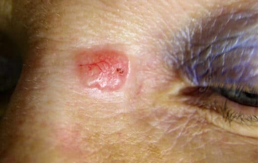 Carcinome basocellulaire traitement naturel