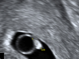 Echographie 4 semaine de grossesse