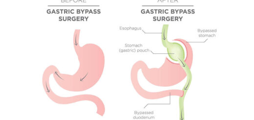 Gastric bypass effets secondaires