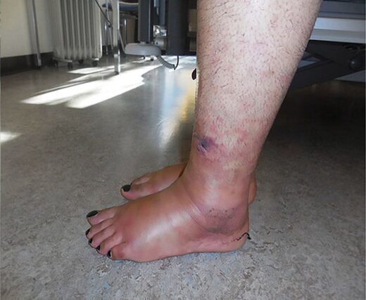 Périartérite noueuse traitement naturel