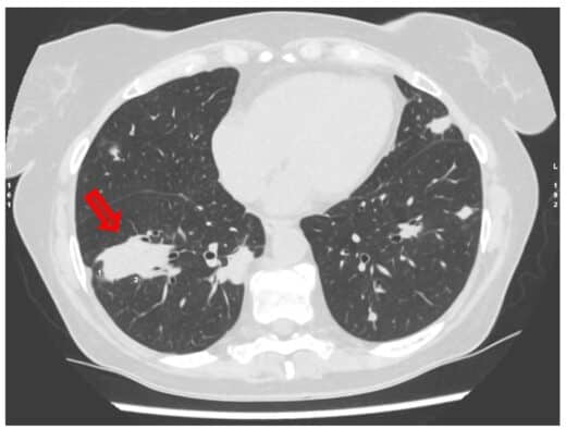 Granulomatose avec polyangéite remède naturel