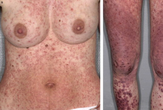 Bouton de grossesse sur le corps