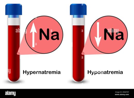 Hypernatrémie traitement naturel