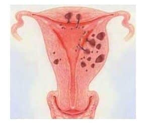 Adenomyosis symptome