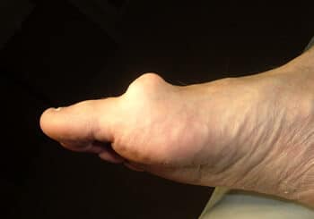 Hallux rigidus traitement naturel