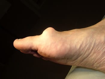 Hallux rigidus traitement naturel