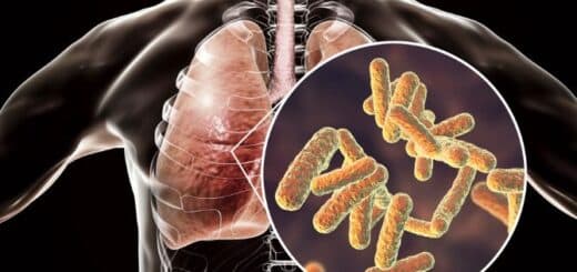 Pneumonia klebsiella traitement naturel