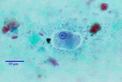 Shigellose traitement naturel curatif