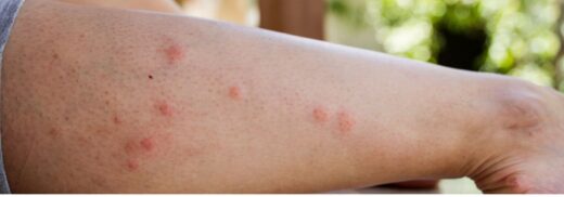 Solutions naturelles piqûre de palmier