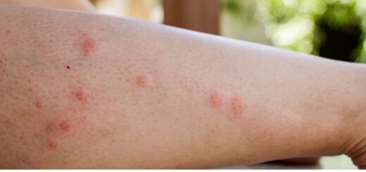 Solutions naturelles piqûre de palmier