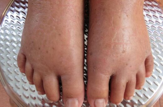 bicarbonate de soude et retention d'eau