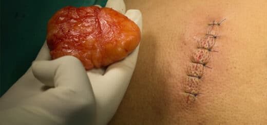 Lipome du dos traitement naturel