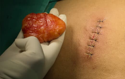 Lipome du dos traitement naturel