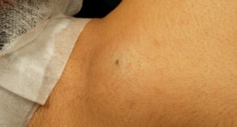 Kyste sous aisselle traitement naturel