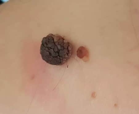 Grain de beauté noir traitement naturel