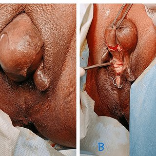 Kyste du pubis traitement naturel