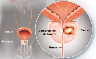 Symptome cancer prostate