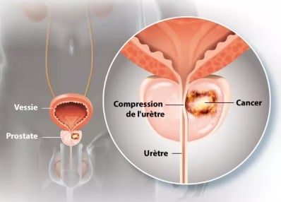Symptome cancer prostate