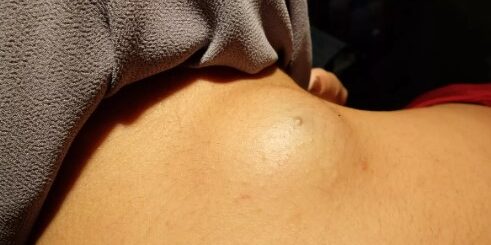 Symptomes lipome cancéreux