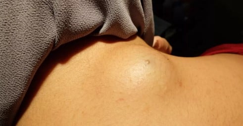 Symptomes lipome cancéreux