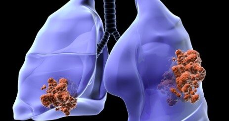 Nodule pulmonaire traitement naturel