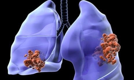 Nodule pulmonaire traitement naturel