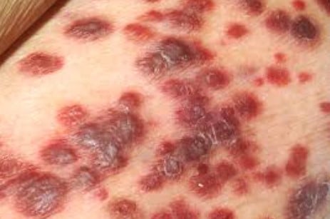 Cancer kaposi traitement naturel